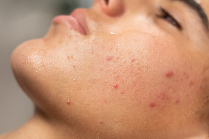 Gros plan sur une joue d'adolescent marquée de boutons d'acné