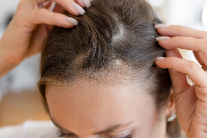 Chute de cheveux réactionnelle