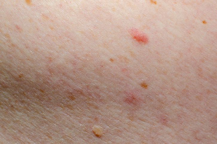 Peau du corps présentant des rougeurs et de petites lésions